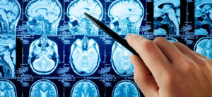 CSF from Alzheimer's Disease Donors